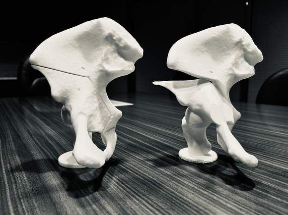 Models of the hip bone, the 4 cuts, and the reorientation of the bone for a PAO Procedure