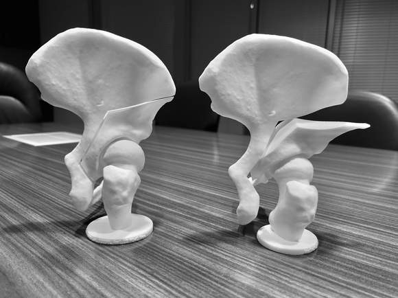 Posterior view of the models of the hip bone, the 4 cuts, and the reorientation of the bone for a PAO Procedure