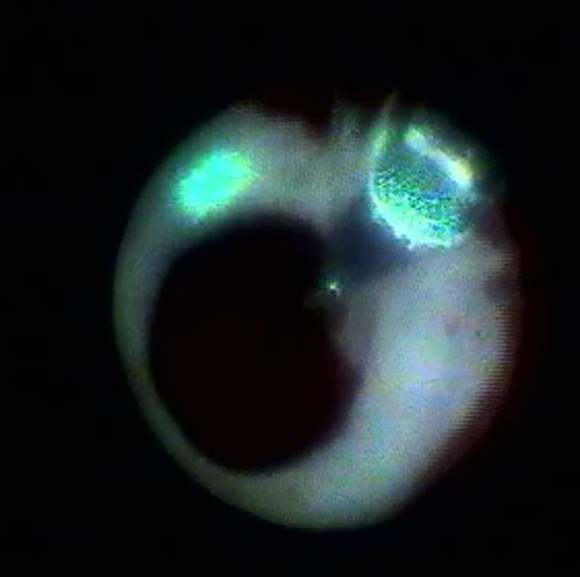 This image, taken during a PVI cardiac ablation procedure, shows the light from the laser as it travels around the interior of a patient's pulmonary vein.